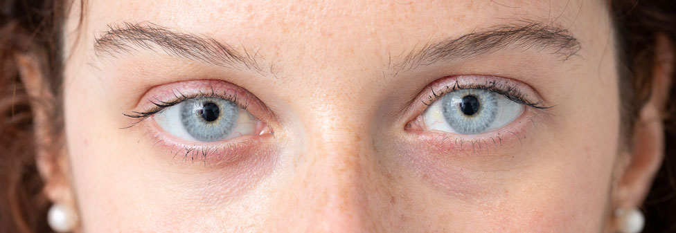 Blue-Eye-after-51-X-